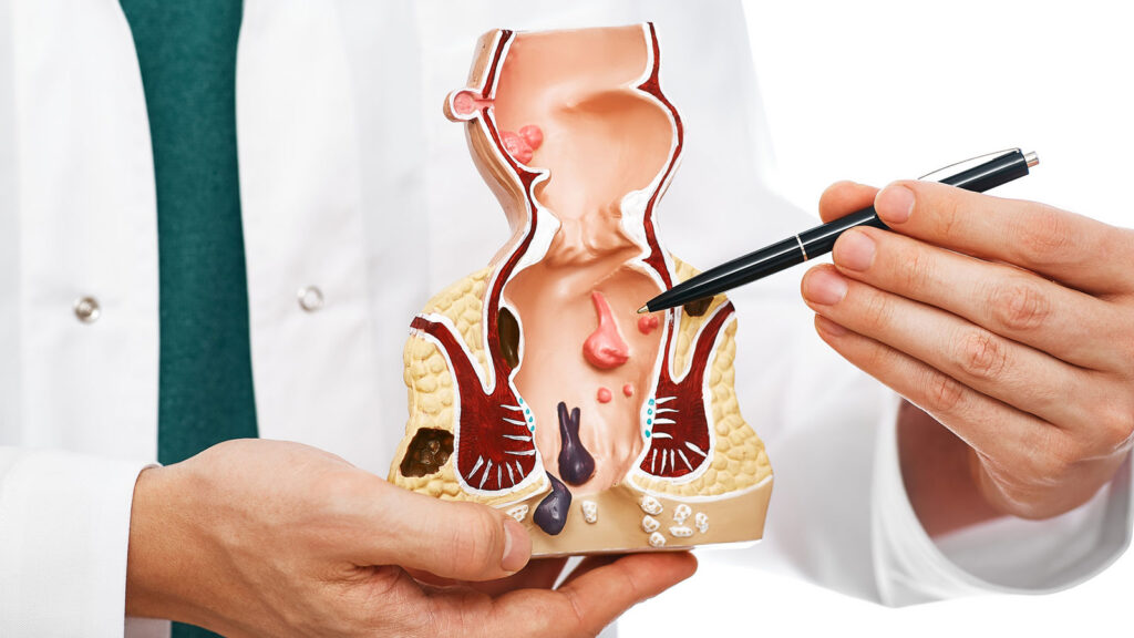 When Should You See a Doctor for Hemorrhoids?